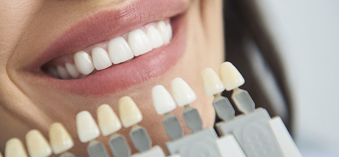 Behandlungen für schöne Zähne in Ortenberg z. B. Bleaching, Veneers